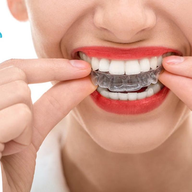 Красивая улыбка с 3D Smile без брекетов