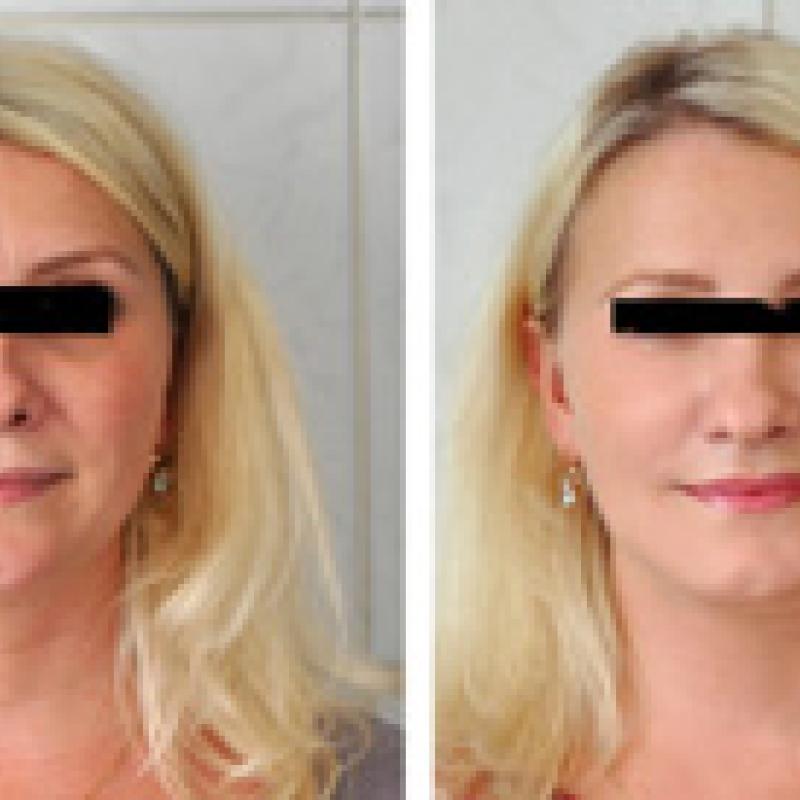 Новая технология омоложения с помощью нитей APTOS Exellence Visage (АПТОС Экселенс Визаж, Россия)